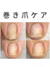【巻き爪ケア】フット巻き爪ケア＋ジェルネイルワンカラー ¥7500～