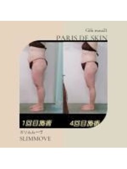 パリス デ スキン 岐阜マーサニジュウイチ店(Paris de skin)/【痩身/ボディ】Before/After