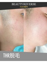ビューティーリバース 横浜店/ メンズひげ脱毛　THR方式脱毛