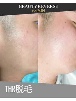 ビューティーリバース 横浜店/ メンズひげ脱毛　THR方式脱毛
