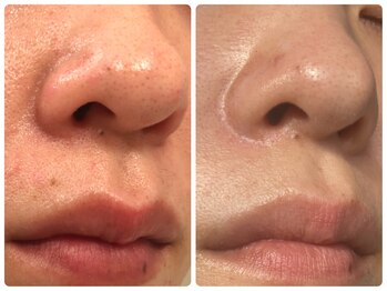 肌質改善サロン　Humming skin【3/2 NEW OPEN（予定）】/ハーブピーリング/敏感肌ケア