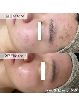 ネイルズビー 別邸(Nail's be)/ハーブピーリング【ニギビ肌】