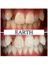 アース(EARTH)/【ビフォーアフター】美白