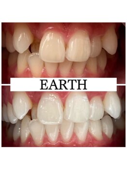 アース(EARTH)/【ビフォーアフター】美白