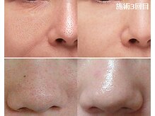 ナチュレアンドメディカ(Nature&Medica)/毛穴集中ケア(Wフェイシャル)