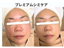 プレジール(plaisir)/シミケアコース