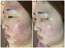 エヌエースキン たまプラーザ店(NAskin)/ハーブピーリング｜美白ケア