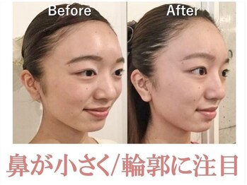 ラプリボーテ(Raplit BEAUTE)/隆鼻＋輪郭矯正40分10回