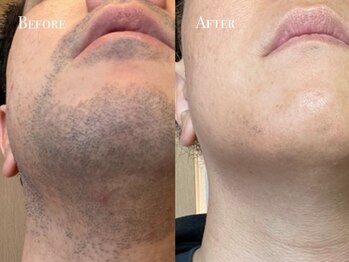 イースト(EAST)/ヒゲ脱毛10回以上