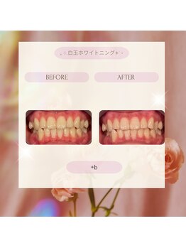 プラスビー 2号店(+b)/ホワイトニングビフォーアフター