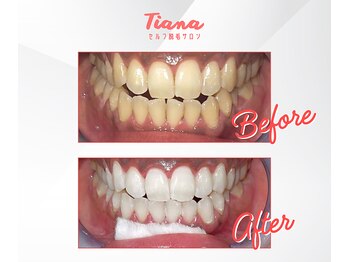 ティアナ 霧島店(Tiana)/ホワイトニング　Before&After