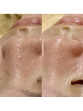 リノア(Lino'aka)/毛穴トルネード洗浄１回の変化