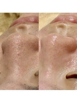 リノア(Lino'aka)/毛穴トルネード洗浄１回の変化