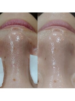 ボーソリューション(Beau-Solution)/【30代　鼻毛穴詰まりケア】