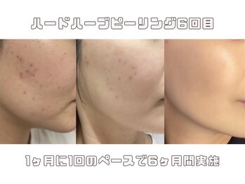 アイル 博多祇園店(iru)/