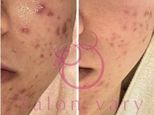 サロンヴェアリー 広尾(salon vary)/水玉&ハーブピーリング