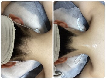 ルルトウキョウ 池袋店(LULU.tokyo)/うなじ脱毛/