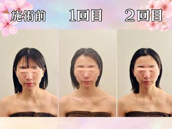 リストアハート(Restore Heart)の写真/変化にビックリ!?驚きの小顔施術が吉祥寺で叶う！お顔のハリやむくみ、歪みを整え理想のフェイスラインに◎