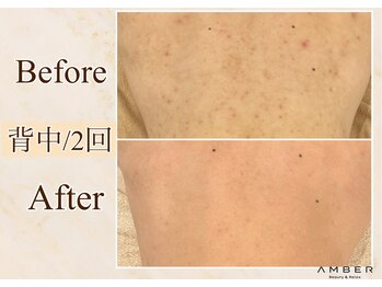 アンバー 恵比寿(AMBER)/ダウンタイム有ハーブピーリング