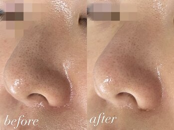 ビューティーサロン プティ(beauty salon petite)/毛穴洗浄×ハーブ/施術3回