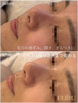 エルビウ(ELBIU)の写真/《よもぎ蒸し×肌質改善》身体の内側から温め、巡りを整えた後にフェイシャルケアでお肌の改善を◇