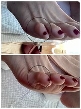 ドクターネイル爪革命 麻布十番店/【魚の目ケア】フットケア