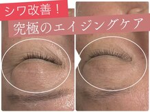 エミニー(Eminy)/プラズマフェイシャル♪