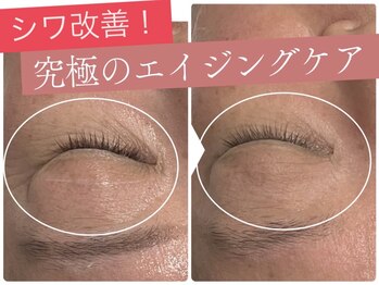 エミニー(Eminy)/プラズマフェイシャル♪