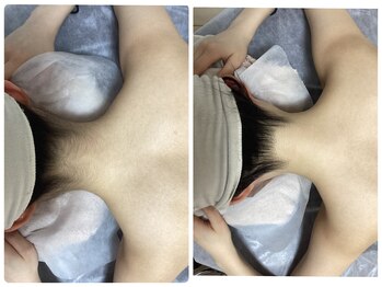 ルルトウキョウ 池袋店(LULU.tokyo)/うなじ脱毛