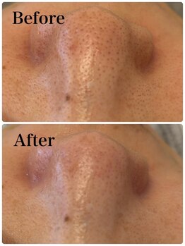 モテ 新宿店(Mote)/ハイドラ毛穴洗浄＋艶肌Wax 新宿