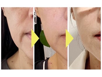 マシェリ(Ma che'rie)/法令線・マリオネットライン撃退