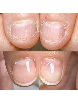 ハッチネイル(HACCI nail)/お客様BeforeAfter 12ヶ月
