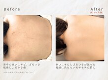 メレ(mele)/30代背中ケア／ニキビケア・毛穴