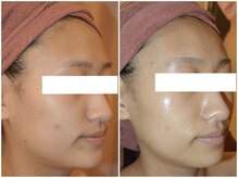 アンシャンテ姫路/30代 ハリツヤ水光肌 姫路エステ