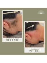 ムー 表参道店(mou)/うなじダブル脱毛before &after
