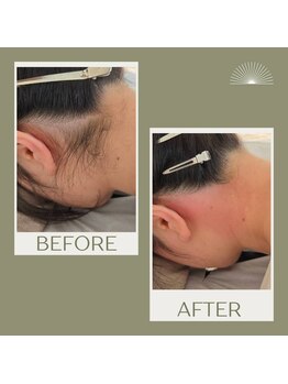 ムー 表参道店(mou)/うなじダブル脱毛before &after