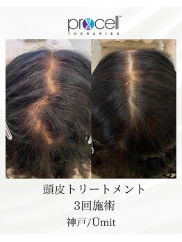 ユミト(Umit)/プロセルスカルプ