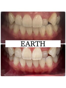 アース(EARTH)/【ビフォーアフター】美白
