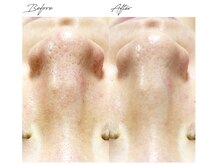 ビズビズ 梅田店(bisebise)/<症例>毛穴詰まり・黒ずみ