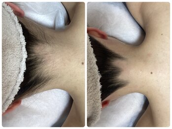 ルルトウキョウ 池袋店(LULU.tokyo)/うなじ脱毛