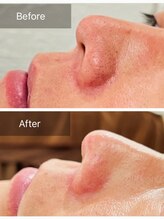 ミュア(myua.)/鼻周りワックス脱毛