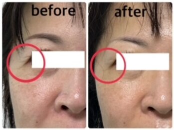 エクラニーク(Eclanique)/目じりのシワが！！