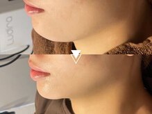 【日本初上陸！】切らずに理想のVライン！医師監修の最新マシンで憧れの小顔へ◎韓国本場インモード￥13000