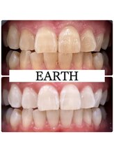 アース(EARTH)/【ビフォーアフター】美白