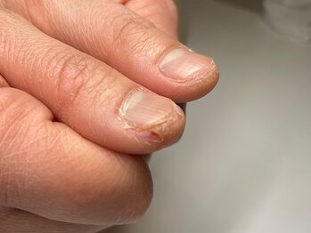 マイントゥーネイル(mine too nail)の写真/隠したいから見せたい爪へ♪【美しく、健康に爪育成を楽しむ。】特殊ネイリストだからできる事◎