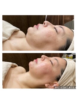 クリスタル(CRYSTAL)/肌質改善 リフトアップ、小顔