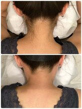 ビープラス(B plus)/プロにお任せうなじ光脱毛♪