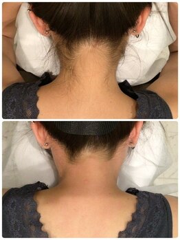 ビープラス(B plus)/プロにお任せうなじ光脱毛♪