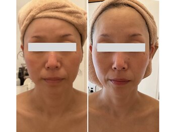 美バストアルファ(美bust α)/【小顔コルギ&バストアップ】