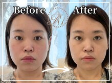 R-1ビューティーサロン 銀座/BEFORE＆AFTER　1回目